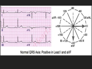 Comprehensive Guide to EKG Interpretation and Cardiac Conduction Blocks ...