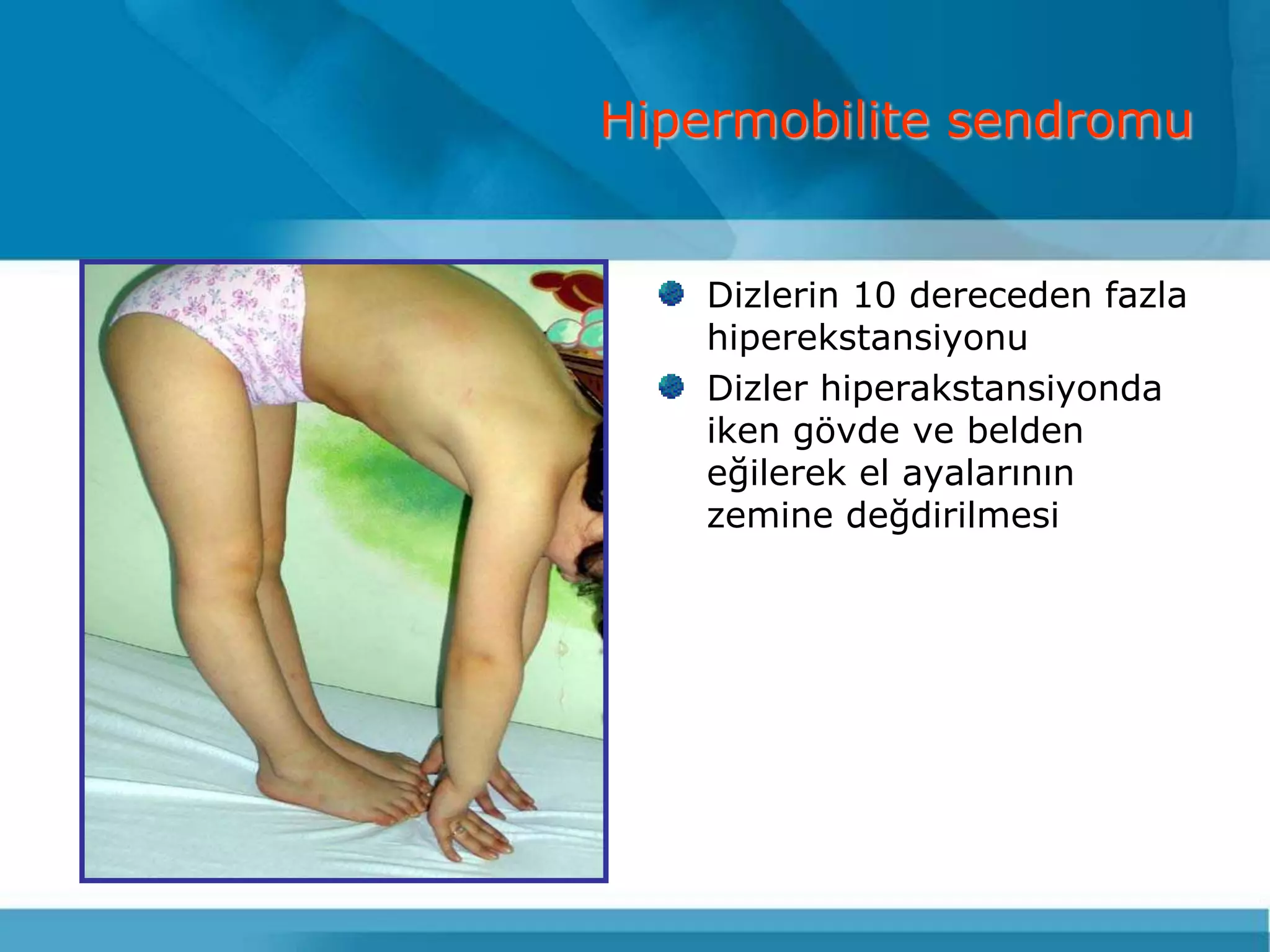 Hipermobilite sendromu


   Dizlerin 10 dereceden fazla
   hiperekstansiyonu
   Dizler hiperakstansiyonda
   iken gövde ve belden
   eğilerek el ayalarının
   zemine değdirilmesi
 