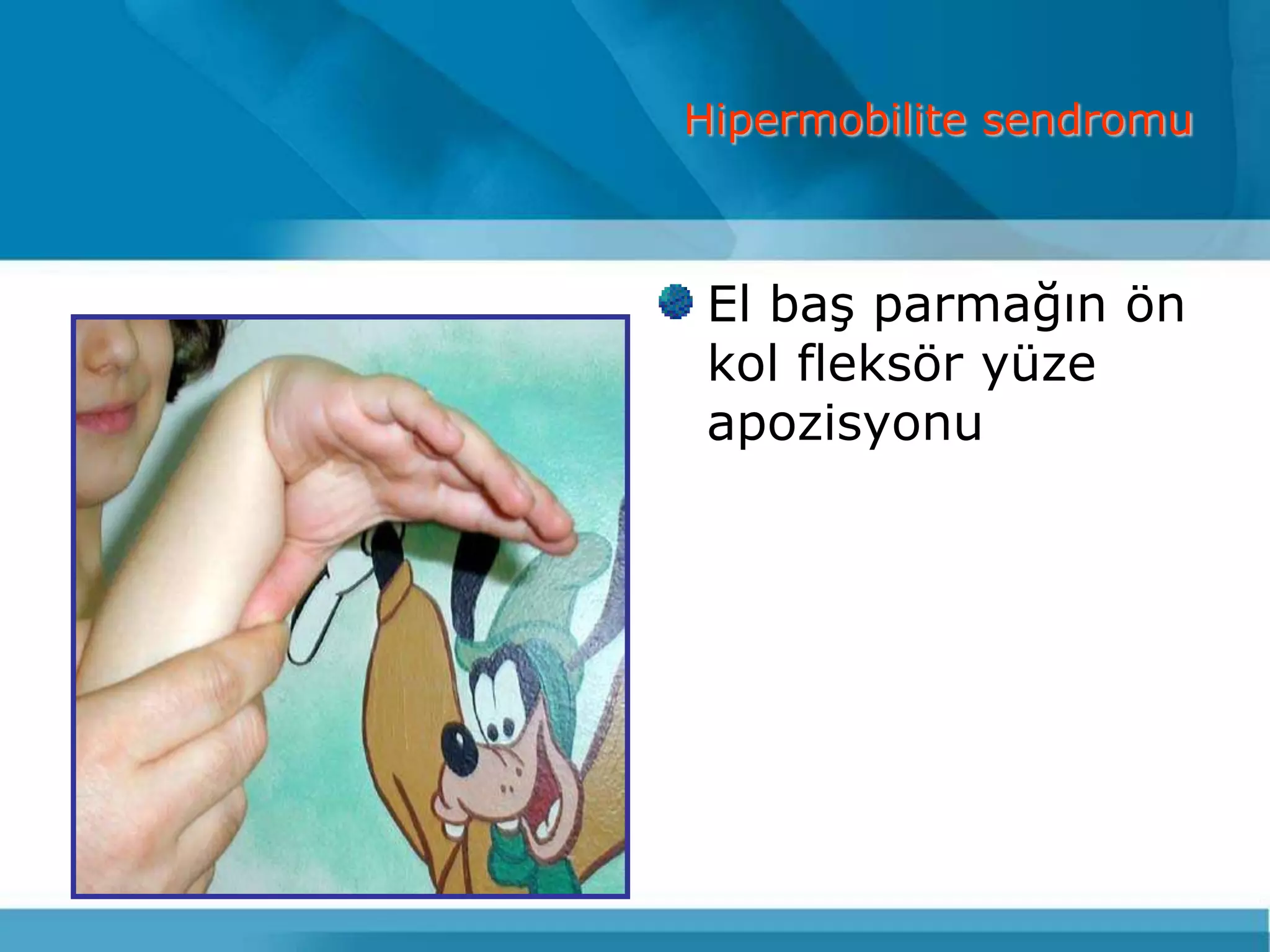 Hipermobilite sendromu



 El baĢ parmağın ön
 kol fleksör yüze
 apozisyonu
 