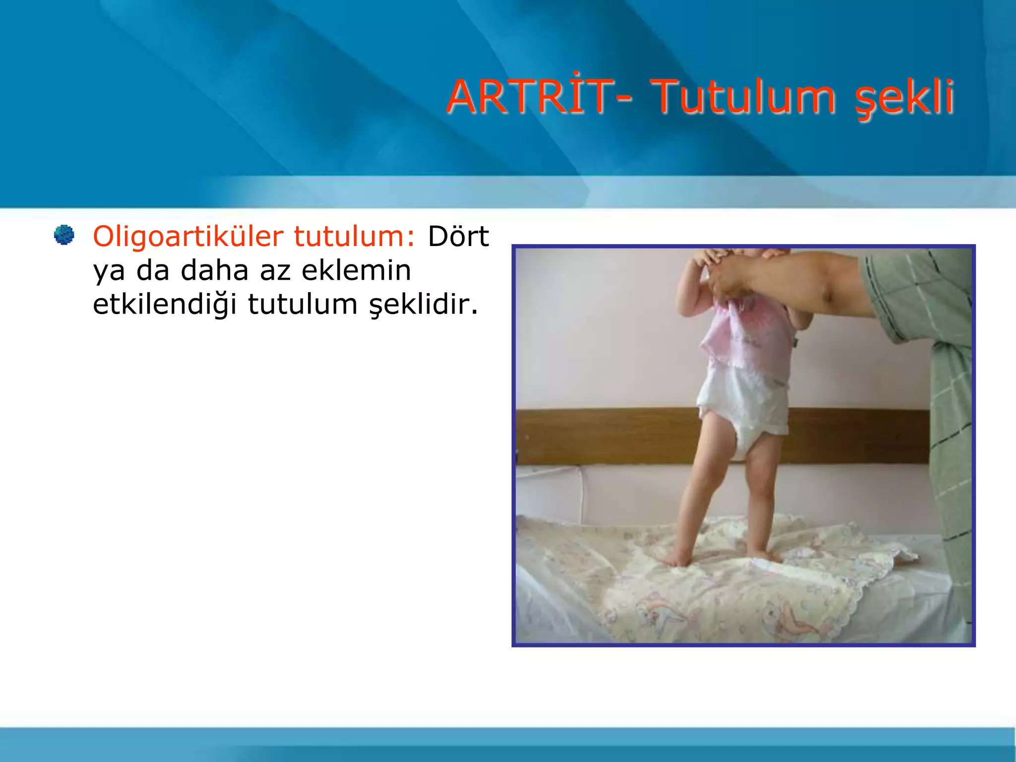 ARTRĠT- Tutulum Ģekli

Oligoartiküler tutulum: Dört
ya da daha az eklemin
etkilendiği tutulum Ģeklidir.
 