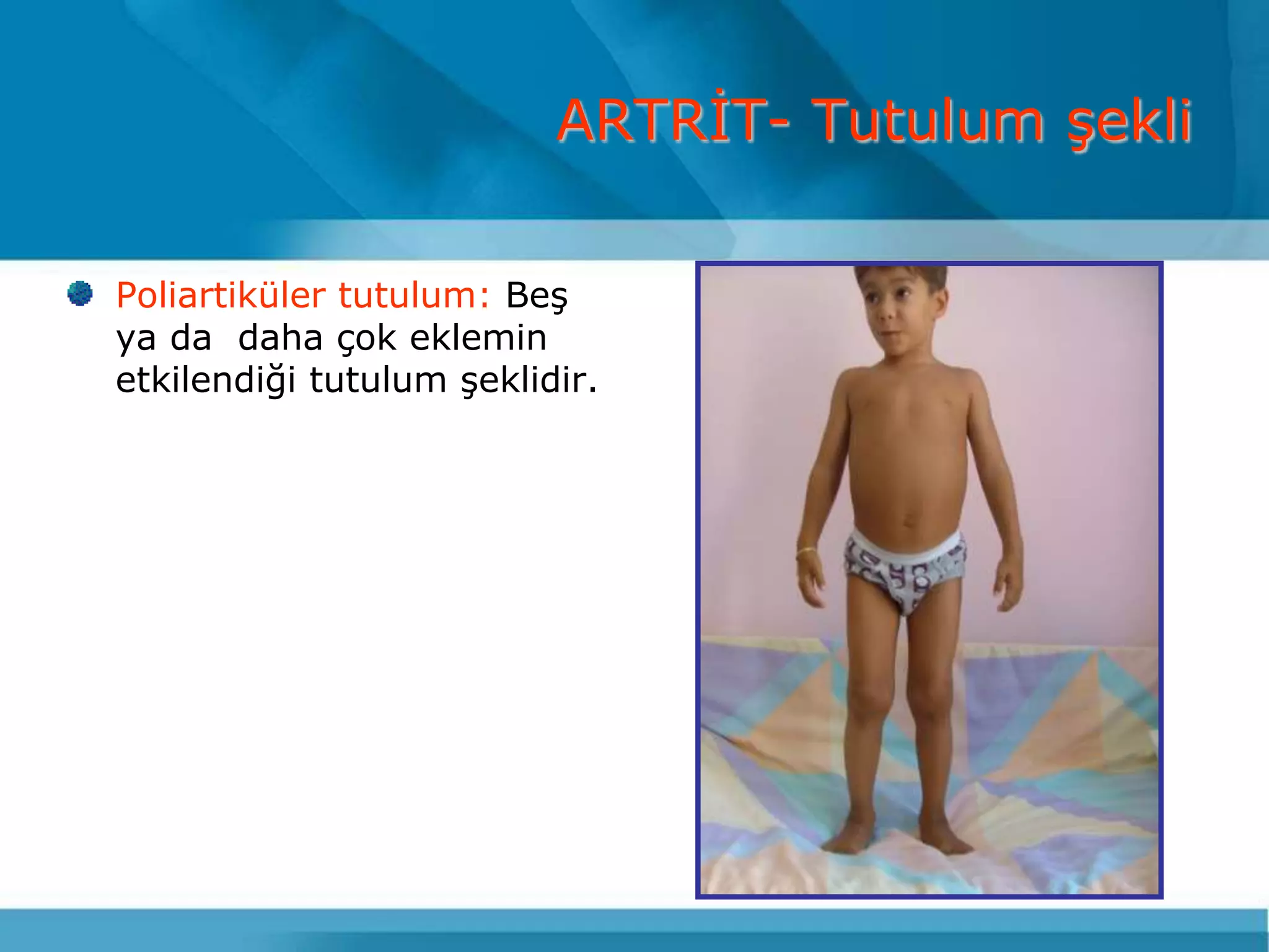 ARTRĠT- Tutulum Ģekli

Poliartiküler tutulum: BeĢ
ya da daha çok eklemin
etkilendiği tutulum Ģeklidir.
 