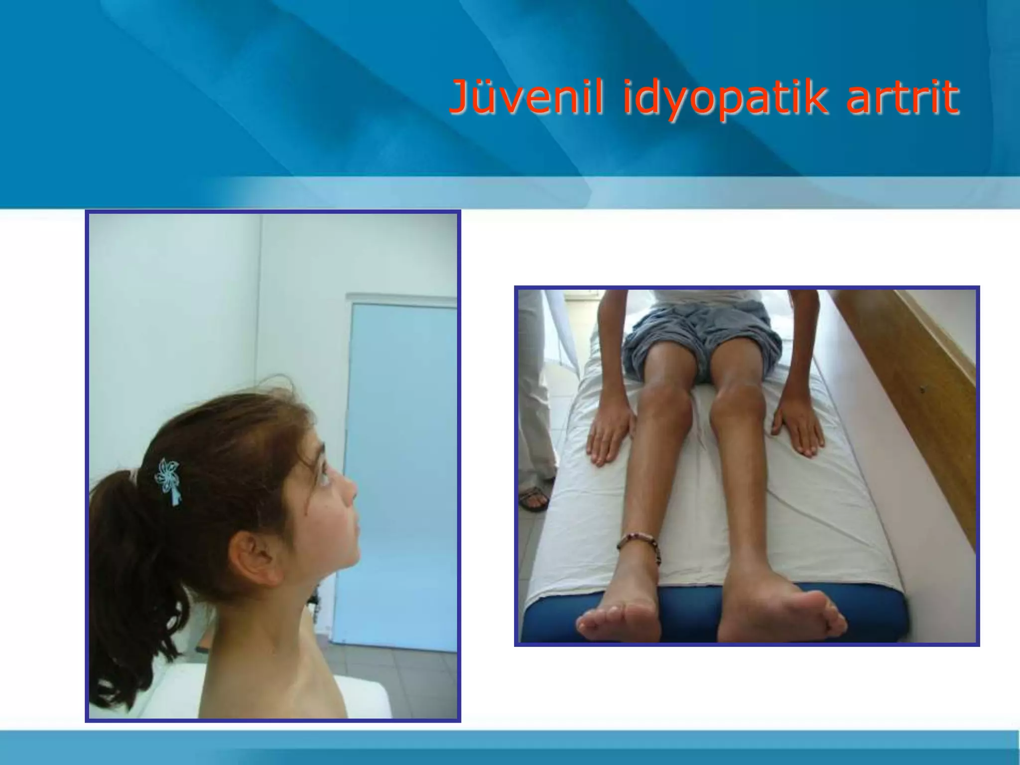 Jüvenil idyopatik artrit
 