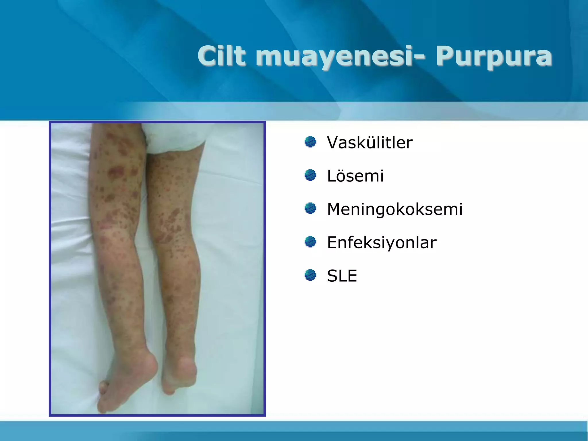 Cilt muayenesi- Purpura


        Vaskülitler

        Lösemi

        Meningokoksemi

        Enfeksiyonlar

        SLE
 