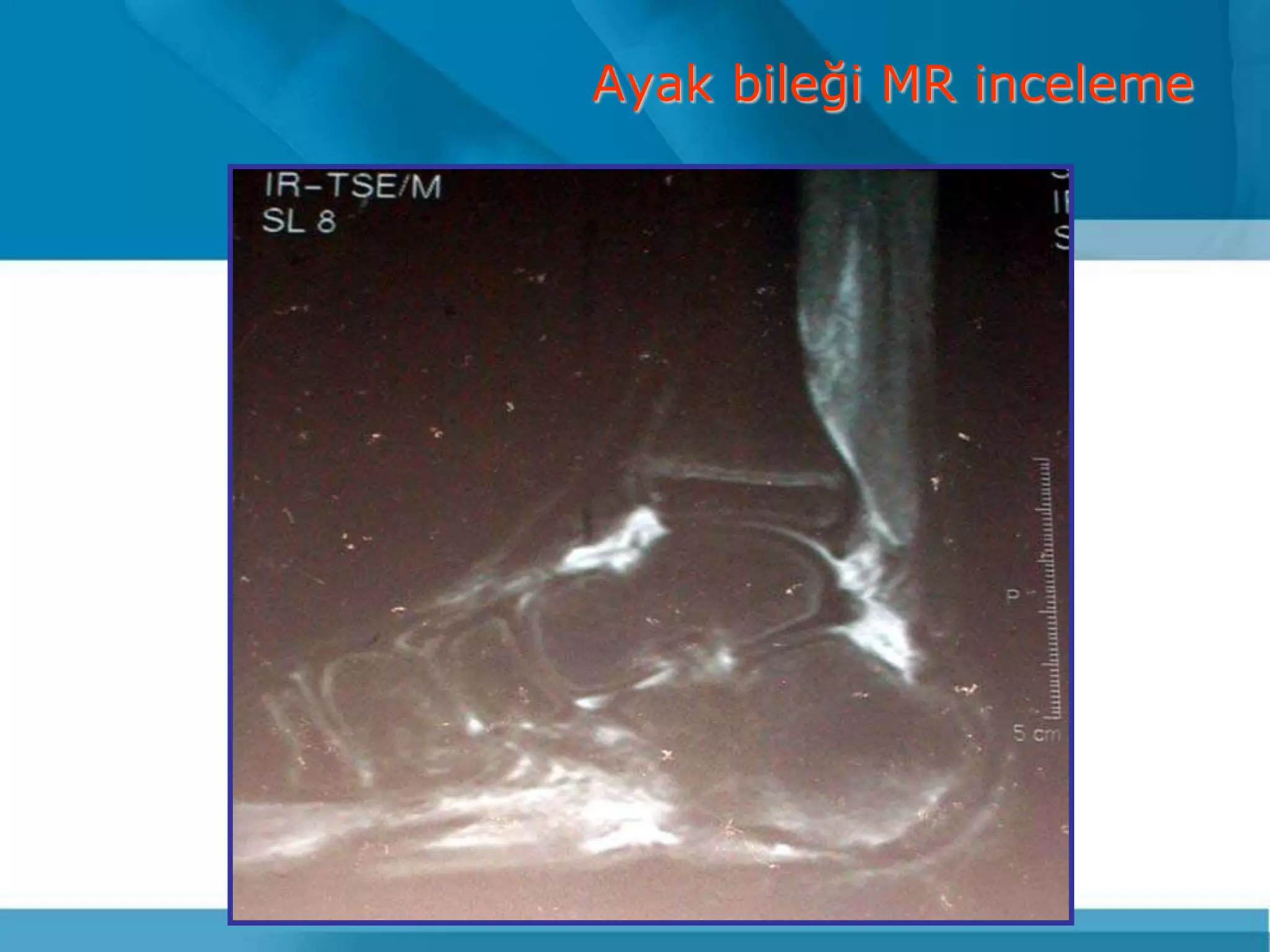 Ayak bileği MR inceleme
 