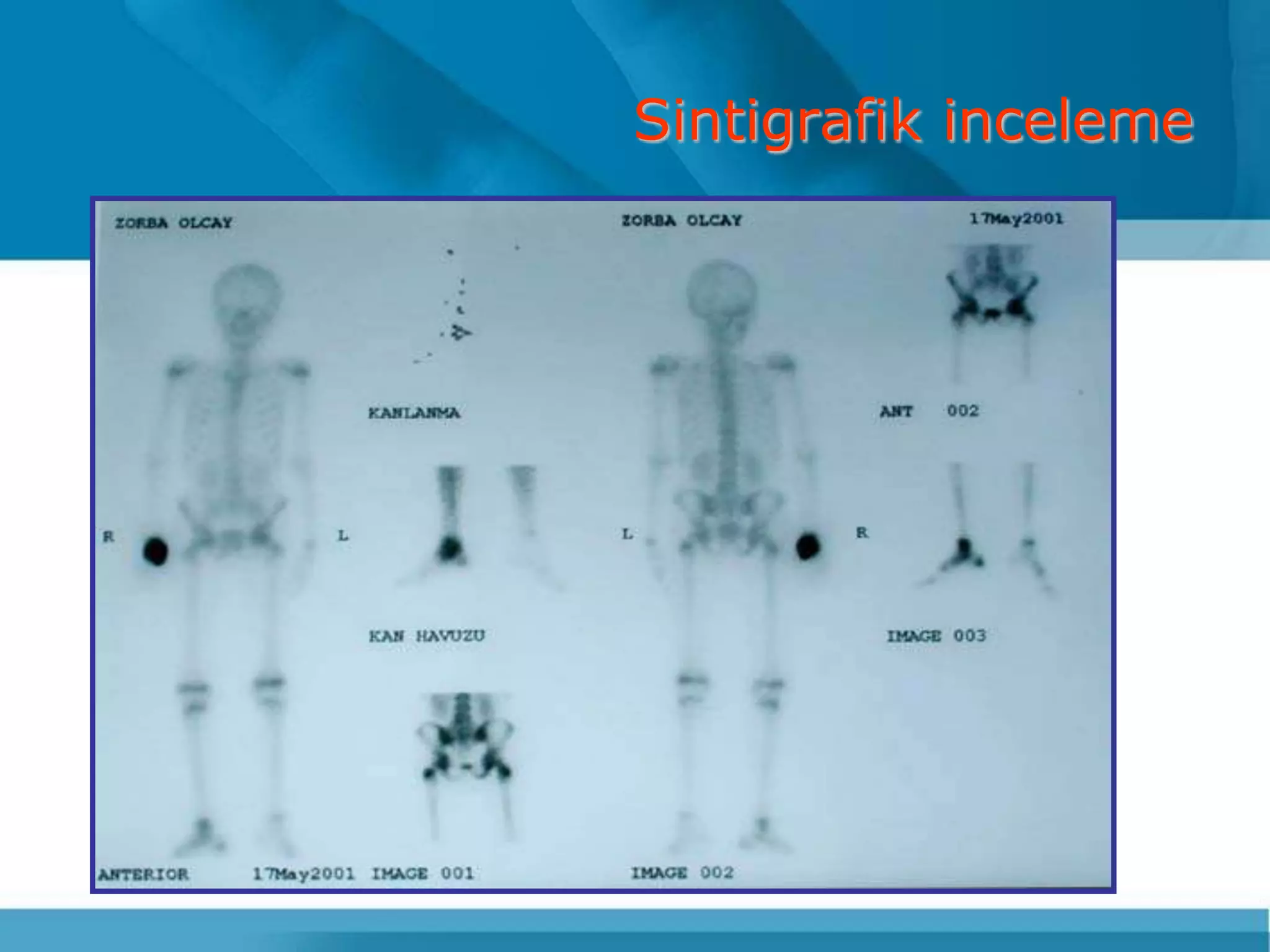 Sintigrafik inceleme
 