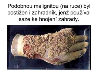 Podobnou malignitou (na ruce) byl postižen i zahradník, jenž používal saze ke hnojení zahrady. 