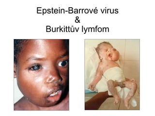 Epstein-Barrové virus & Burkittův lymfom 