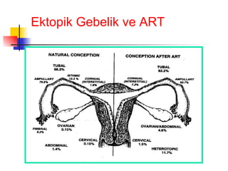 Ektopik Gebelik ve ART 