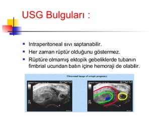 USG Bulguları : Intraperitoneal sıvı saptanabilir. Her zaman rüptür olduğunu göstermez. Rüptüre olmamış ektopik gebeliklerde tubanın fimbrial ucundan batın içine hemoraji de olabilir. 