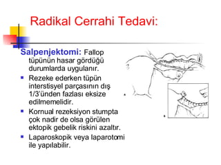 Radikal Cerrahi Tedavi: Salpenjektomi:   Fallop tüpünün hasar gördüğü durumlarda uygulanır. Rezeke ederken tüpün interstisyel parçasının dış 1/3’ünden fazlası eksize edilmemelidir. Kornual rezeksiyon stumpta çok nadir de olsa görülen ektopik gebelik riskini azaltır. Laparoskopik veya laparotomi ile yapılabilir. 