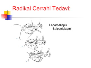 Radikal Cerrahi Tedavi: Laparoskopik Salpenjektomi 