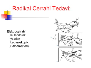 Radikal Cerrahi Tedavi: Elektrocerrahi kullanılarak yapılan Laparoskopik Salpenjektomi 
