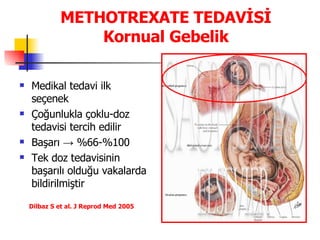 METHOTREXATE   TEDAVİSİ Kornual Gebelik Medikal tedavi ilk seçenek Çoğunlukla çoklu-doz tedavisi tercih edilir Başarı  ->  %66-%100 Tek doz tedavisinin başarılı olduğu vakalarda bildirilmiştir    Dilbaz S  et al.  J Reprod Med 2005 