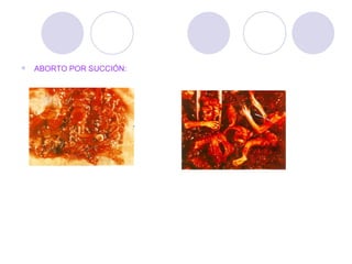 ABORTO POR SUCCIÓN: 