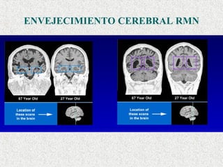 ENVEJECIMIENTO CEREBRAL RMN 