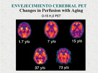 ENVEJECIMIENTO CEREBRAL PET 
