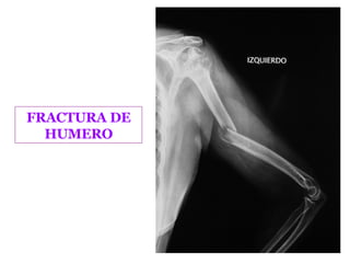 FRACTURA DE HUMERO 