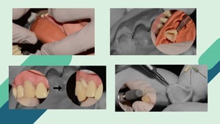 Elaboracion de Prótesis Provisionales.pptx