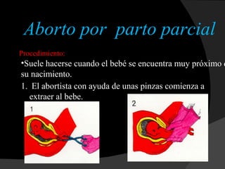 Aborto por  parto parcial   Suele hacerse cuando el bebé se encuentra muy próximo de su nacimiento. Procedimiento: El abortista con ayuda de unas pinzas comienza a extraer al bebe. 