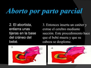 2. El abortista, entierra unas tijeras en la base del cráneo del bebé.   3. Entonces inserta un catéter y extrae el cerebro mediante succión. Este procedimiento hace que el bebé muera y que su cabeza se desplome.   Aborto por parto parcial  