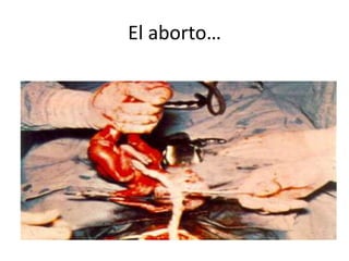 El aborto… 