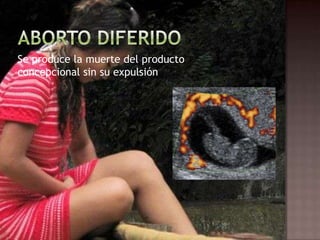 Se produce la muerte del producto
concepcional sin su expulsión
 