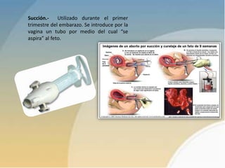 Succión.- Utilizado durante el primer
trimestre del embarazo. Se introduce por la
vagina un tubo por medio del cual “se
aspira” al feto.
 