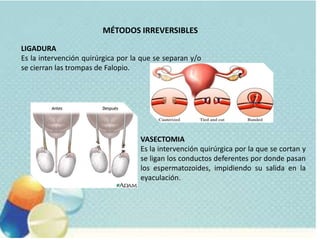 MÉTODOS IRREVERSIBLES
LIGADURA
Es la intervención quirúrgica por la que se separan y/o
se cierran las trompas de Falopio.
VASECTOMIA
Es la intervención quirúrgica por la que se cortan y
se ligan los conductos deferentes por donde pasan
los espermatozoides, impidiendo su salida en la
eyaculación.
 