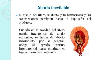 Aborto inevitable
 El cuello del útero se dilata y la hemorragia y las
contracciones persisten hasta la expulsión del
producto.
Cuando en la cavidad del útero
queda fragmentos de tejido
corionico, se habla de aborto
incompleto, por lo general,
obliga al legrado uterino
instrumental para eliminar el
tejido placentario retenido.
 