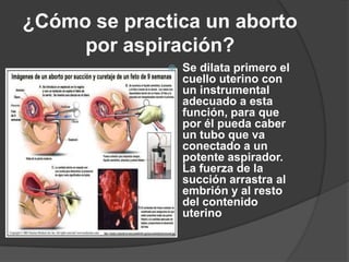 ¿Cómo se practica un aborto por aspiración?Se dilata primero el cuello uterino con un instrumental adecuado a esta función, para que por él pueda caber un tubo que va conectado a un potente aspirador. La fuerza de la succión arrastra al embrión y al resto del contenido uterino