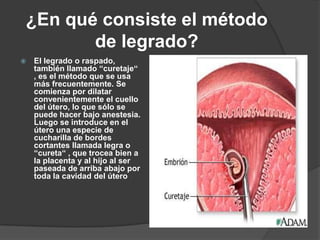 ¿En qué consiste el método de legrado? El legrado o raspado, también llamado “curetaje“ , es el método que se usa más frecuentemente. Se comienza por dilatar convenientemente el cuello del útero, lo que sólo se puede hacer bajo anestesia. Luego se introduce en el útero una especie de cucharilla de bordes cortantes llamada legra o “cureta“ , que trocea bien a la placenta y al hijo al ser paseada de arriba abajo por toda la cavidad del útero