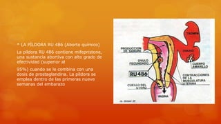 * LA PÍLDORA RU 486 (Aborto químico) 
La píldora RU 486 contiene mifepristone, 
una sustancia abortiva con alto grado de 
efectividad (superior al 
95%) cuando se le combina con una 
dosis de prostaglandina. La píldora se 
emplea dentro de las primeras nueve 
semanas del embarazo 
 