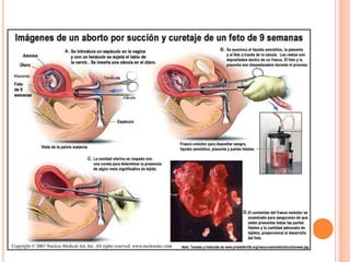 El aborto 