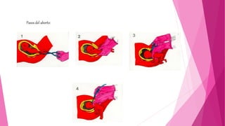 Pasos del aborto:
 