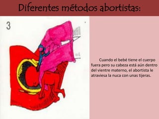 Diferentes métodos abortistas:




                      Cuando el bebé tiene el cuerpo
                 fuera pero su cabeza está aún dentro
                 del vientre materno, el abortista le
                 atraviesa la nuca con unas tijeras.
 