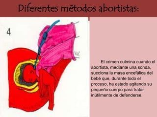 Diferentes métodos abortistas:




                        El crimen culmina cuando el
                  abortista, mediante una sonda,
                  succiona la masa encefálica del
                  bebé que, durante todo el
                  proceso, ha estado agitando su
                  pequeño cuerpo para tratar
                  inútilmente de defenderse.
 