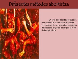 Diferentes métodos abortistas:


                         En este otro aborto por succión
                de un bebé de 10 semanas es posible
                ver claramente sus pequeños miembros
                destrozados luego de pasar por el tubo
                de la aspiradora.
 