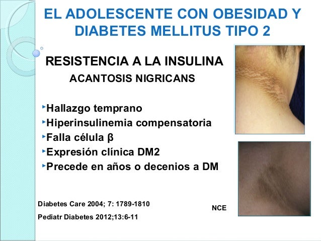 El adolescente con obesidad y diabetes mellitus tipo 2, su El adolescente con obesidad y diabetes mellitus tipo 2, su