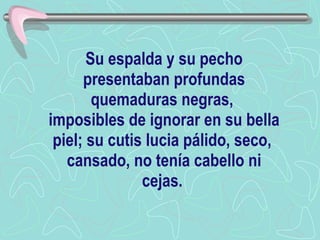 Su espalda y su pecho presentaban profundas quemaduras negras,  imposibles de ignorar en su bella piel; su cutis lucia pálido, seco,  cansado, no tenía cabello ni cejas.   