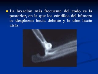  La luxación más frecuente del codo es la
posterior, en la que los cóndilos del húmero
se desplazan hacia delante y la ulna hacia
atrás.
 