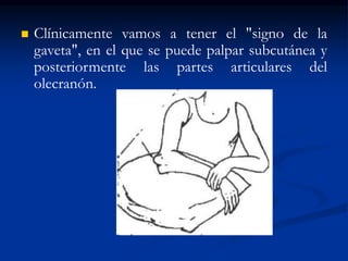  Clínicamente vamos a tener el "signo de la
gaveta", en el que se puede palpar subcutánea y
posteriormente las partes articulares del
olecranón.
 