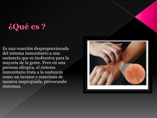 Es una reacción desproporcionada
del sistema inmunitario a una
sustancia que es inofensiva para la
mayoría de la gente. Pero en una
persona alérgica, el sistema
inmunitario trata a la sustancia
como un invasor y reacciona de
manera inapropiada, provocando
síntomas.
 