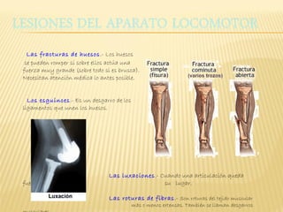   Las fracturas de huesos.- Los huesos
  se pueden romper si sobre ellos actúa una
fuerza muy grande (sobre todo si es brusca).
Necesitan atención médica lo antes posible.
 
 
   Los esguinces.- Es un desgarro de los
ligamentos que unen los huesos.




                                Las luxaciones.- Cuando una articulación queda
fuera de                                          su lugar.

                                Las roturas de fibras .- Son roturas del tejido muscular
                                        más o menos extensas. También se llaman desgarros
 