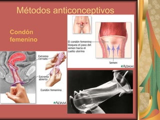 Métodos anticonceptivos
Condón
femenino
 