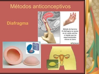 Métodos anticonceptivos
Diafragma
 