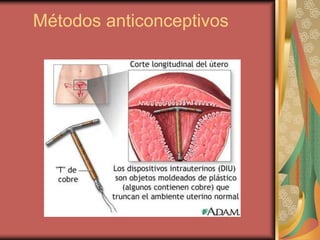 Métodos anticonceptivos
 