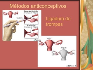 Métodos anticonceptivos
Ligadura de
trompas
 