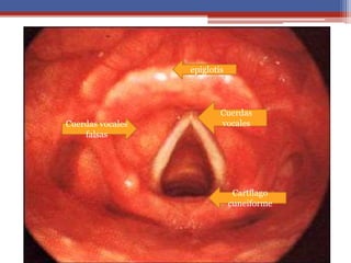 epiglotis
Cuerdas
vocales
Cartílago
cuneiforme
Cuerdas vocales
falsas
 
