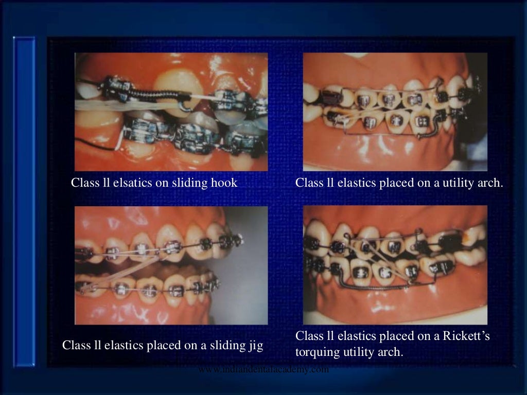 Elastics in orthodontics /certified fixed orthodontic courses by Indi…