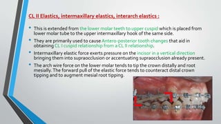 CL II Elastics, intermaxillary elastics, interarch elastics :
• This is extended from the lower molar teeth to upper cuspid which is placed from
lower molar tube to the upper intermaxillary hook of the same side.
• They are primarily used to cause Antero-posterior tooth changes that aid in
obtaining CL I cuspid relationship from a CL II relationship.
• Intermaxillary elastic force exerts pressure on the incisor in a vertical direction
bringing them into supraocclusion or accentuating supraocclusion already present.
• The arch wire force on the lower molar tends to tip the crown distally and root
mesially.The forward pull of the elastic force tends to counteract distal crown
tipping and to augment mesial root tipping.
 